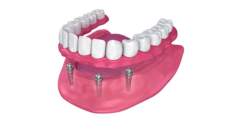 An image demonstrating how Denture Over Implants work